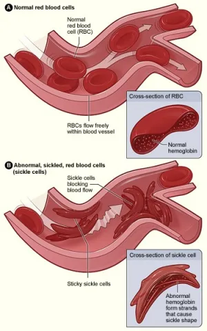 Diagram showing sickle cells versus typical blood cells.