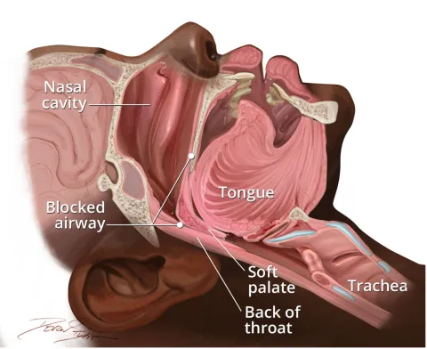 Diagram showing the elements leading to sleep apnea