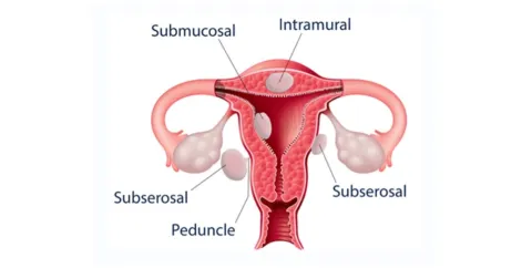 Diagram showing fibroids in the female reproductive system