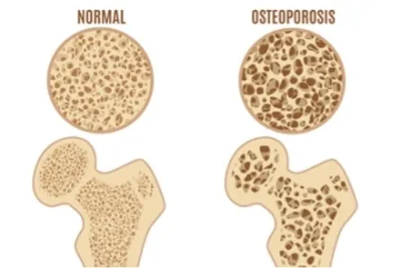 Diagram of bone tissue with and without osteoporosis